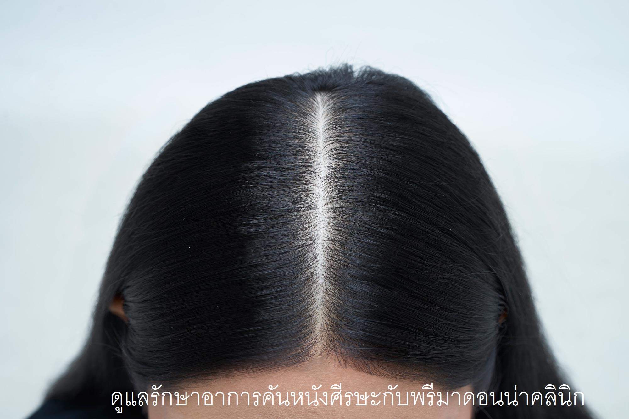 5 Irritating Scalp Problems in Women!