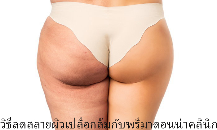Venus Legacy for Reduce Cellulite in Chiangmai