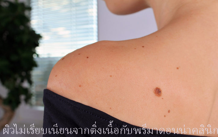 Skin Tags in Chiangmai