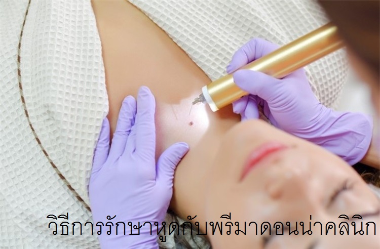 Wart Removal in Chiangmai