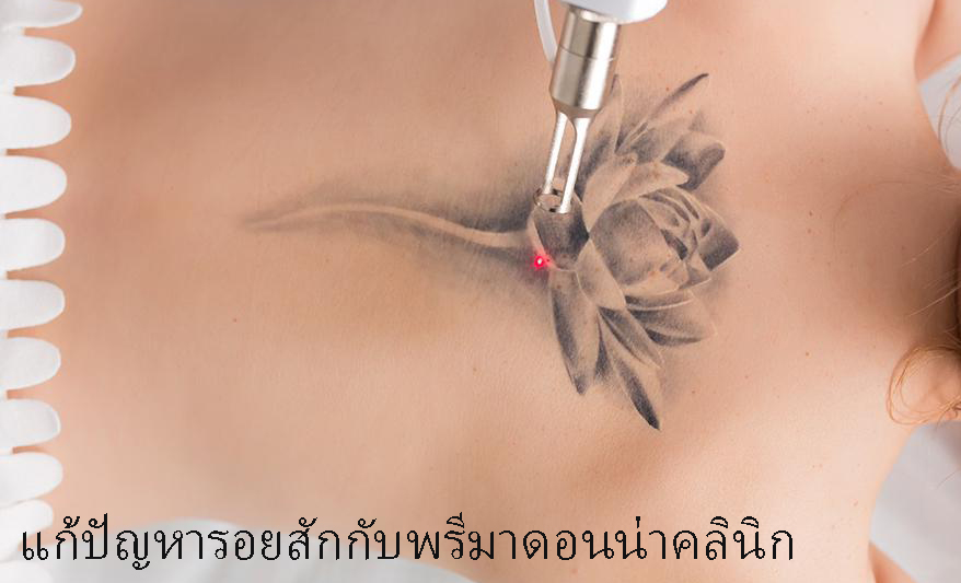 แก้ปัญหารอยสักกับพรีมาดอนน่าคลินิก