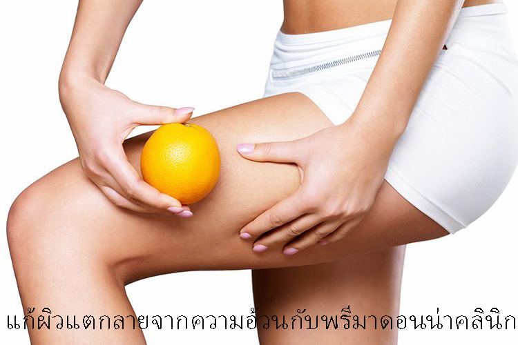 Stretch Mark Removal in Chiangmai