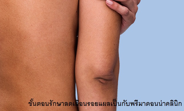 Laser Scar Treatment in Chiangmai