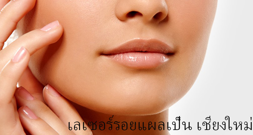 laser scar removal in Chiangmai