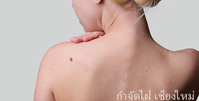 Mole Removal at Chiangmai