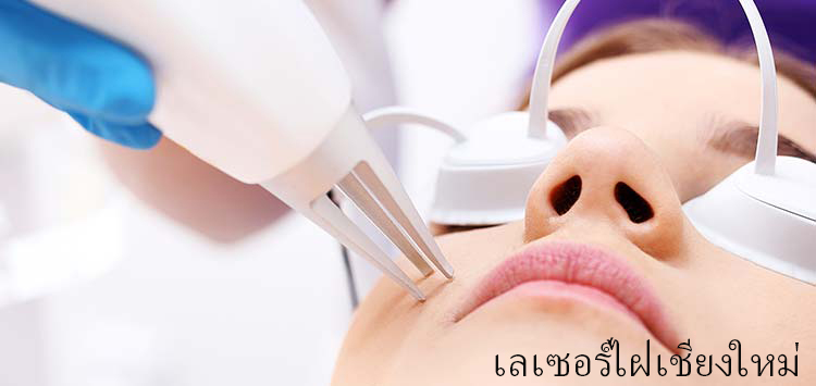 Laser mole removal at Chiangmai