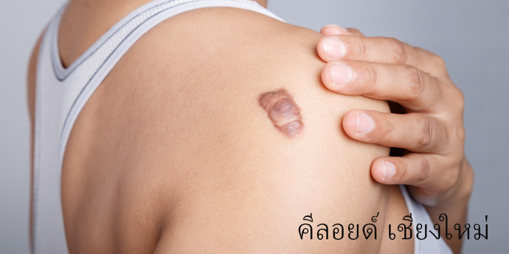 Keloid Scar in Chiangmai